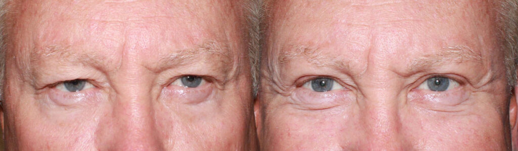 Upper Blepharoplasty before and after photo by Dr. Charles Anthony in Tampa, FL