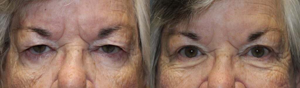 Upper Blepharoplasty before and after photo by Dr. Charles Anthony in Tampa, FL