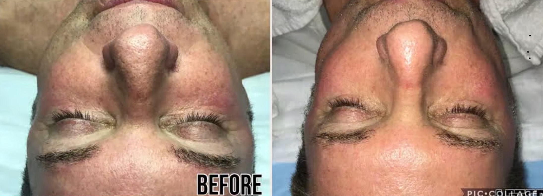 Microneedling before and after photo by Dr. Charles Anthony in Tampa FL