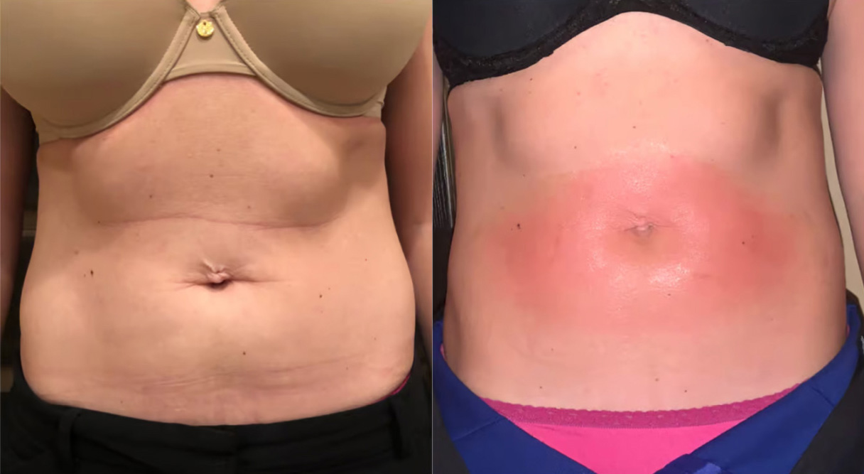 Reshape before and after photo by Dr. Charles Anthony in Tampa FL