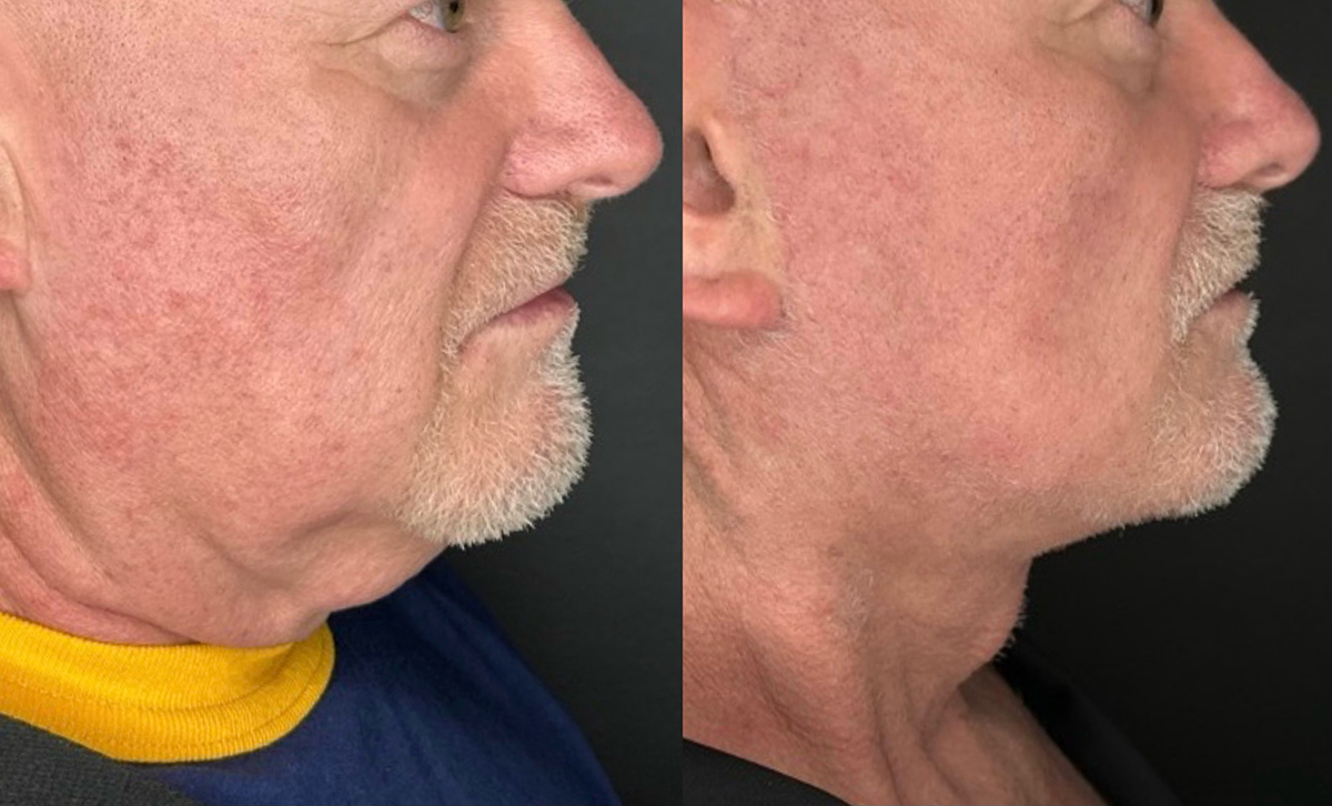 Facelift Before and After Photo by Dr. Charles Anthony in Tampa FL