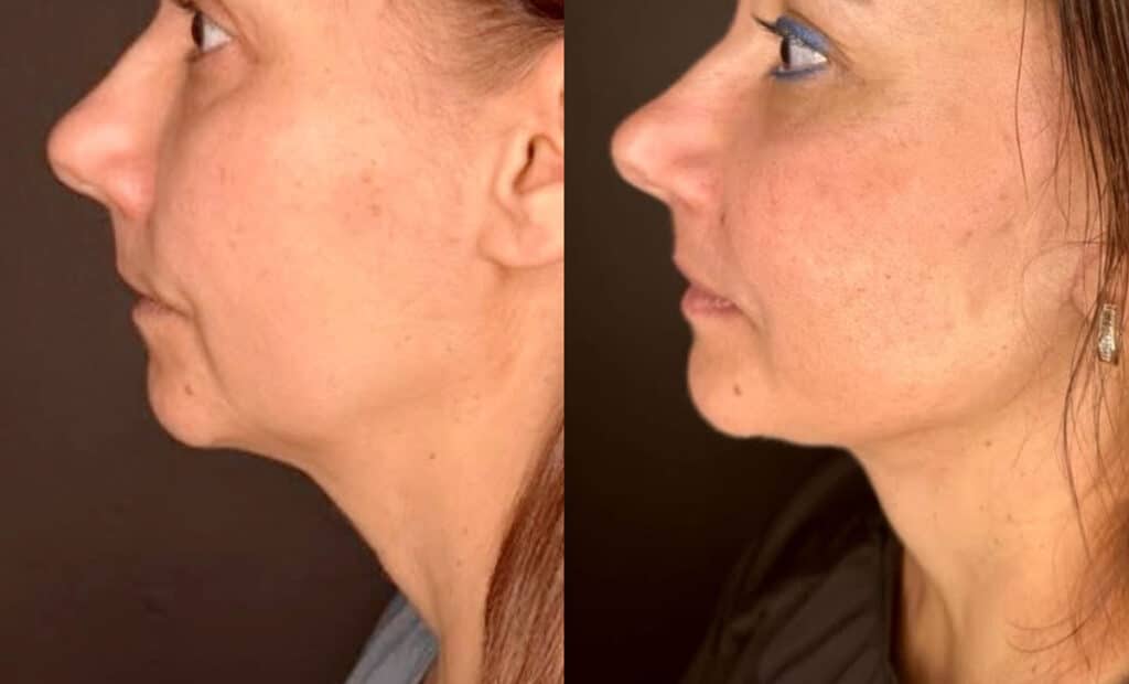 Facelift Before and After Photo by Dr. Charles Anthony in Tampa, FL
