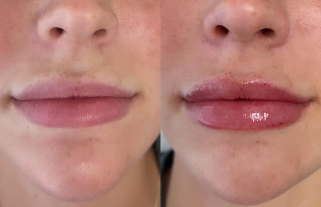 Filler Before and After Photo by Dr. Charles Anthony in Tampa, FL