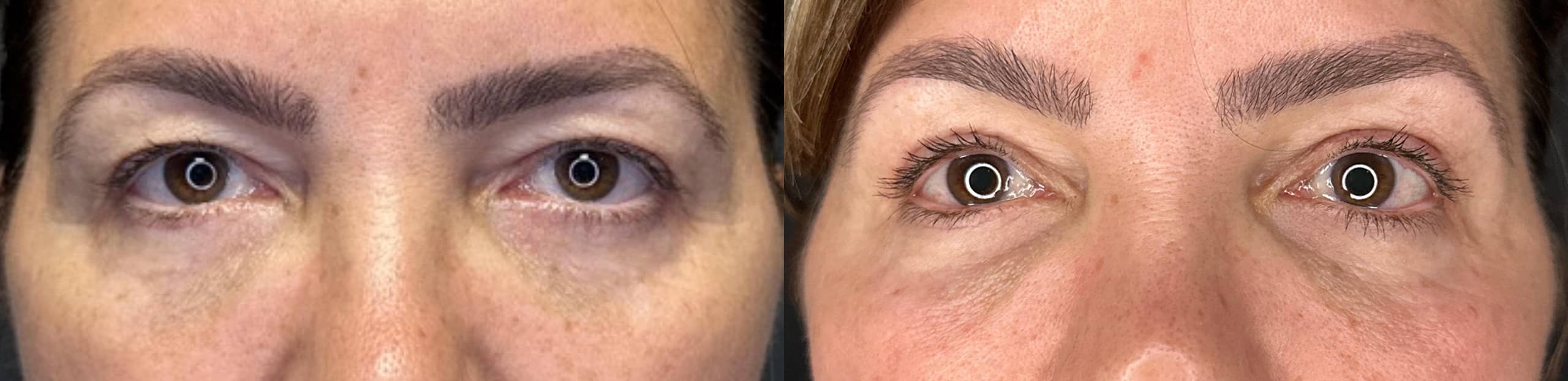 Upper Blepharoplasty Before and After Photo by Dr. Charles Anthony in Tampa, FL