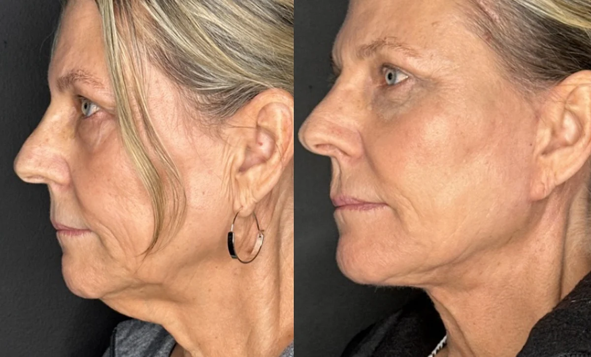 Facelift Before and After Photo by Dr. Charles Anthony in Tampa FL