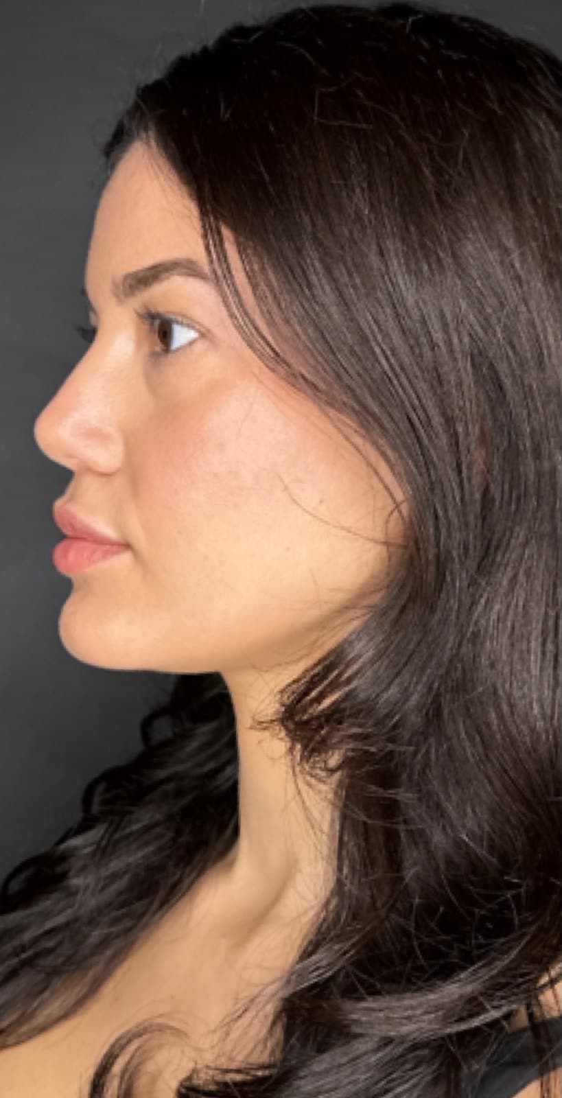 Before Personalized Treatment Plan At Anthony Aesthetics In St. Petersburg, Fl