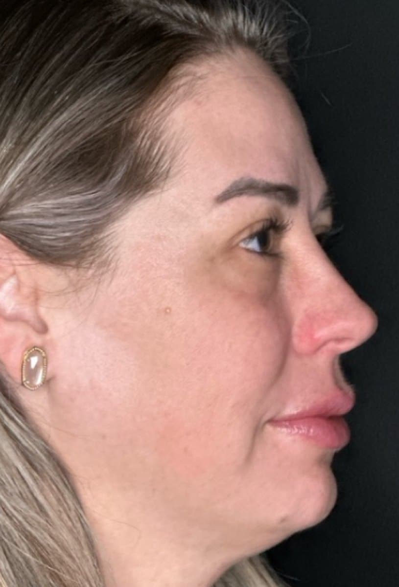 After Co2 Laser Resurfacing Treatment At Anthony Aesthetics In St. Petersburg, Fl