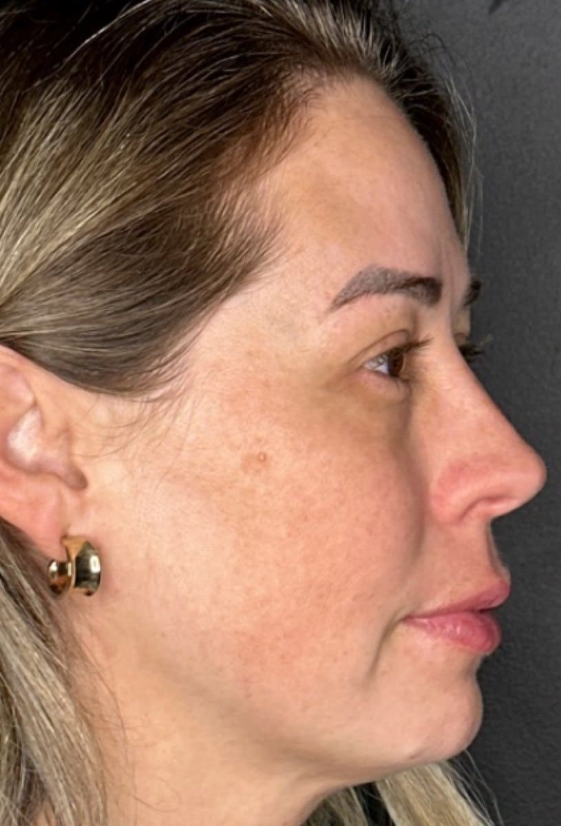Before Co2 Laser Resurfacing Treatment At Anthony Aesthetics In St. Petersburg, Fl