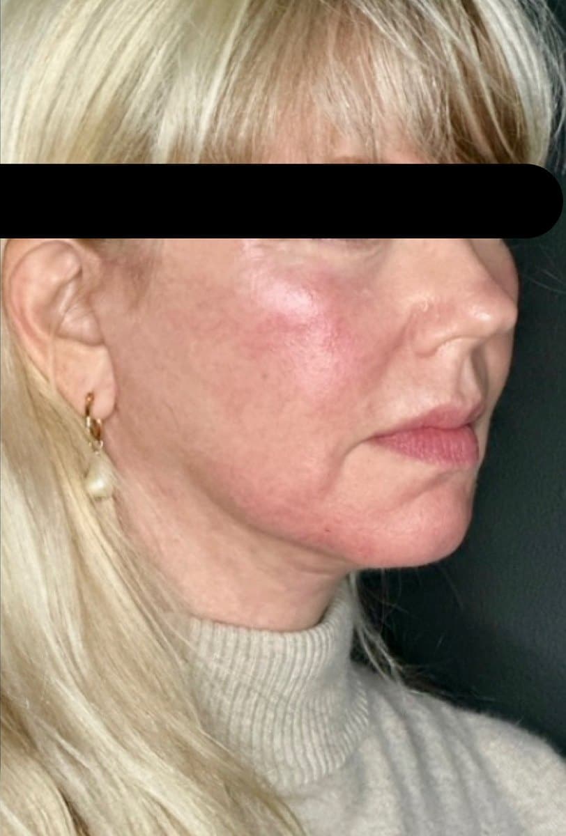 After Facial Rejuvenation Treatment At Anthony Aesthetics In St. Petersburg, Fl