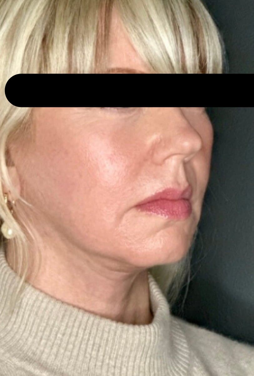 Before Facial Rejuvenation Treatment At Anthony Aesthetics In St. Petersburg, Fl