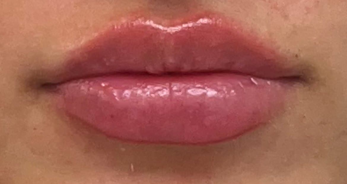 After Lip Filler Treatment At Anthony Aesthetics In St. Petersburg, Fl