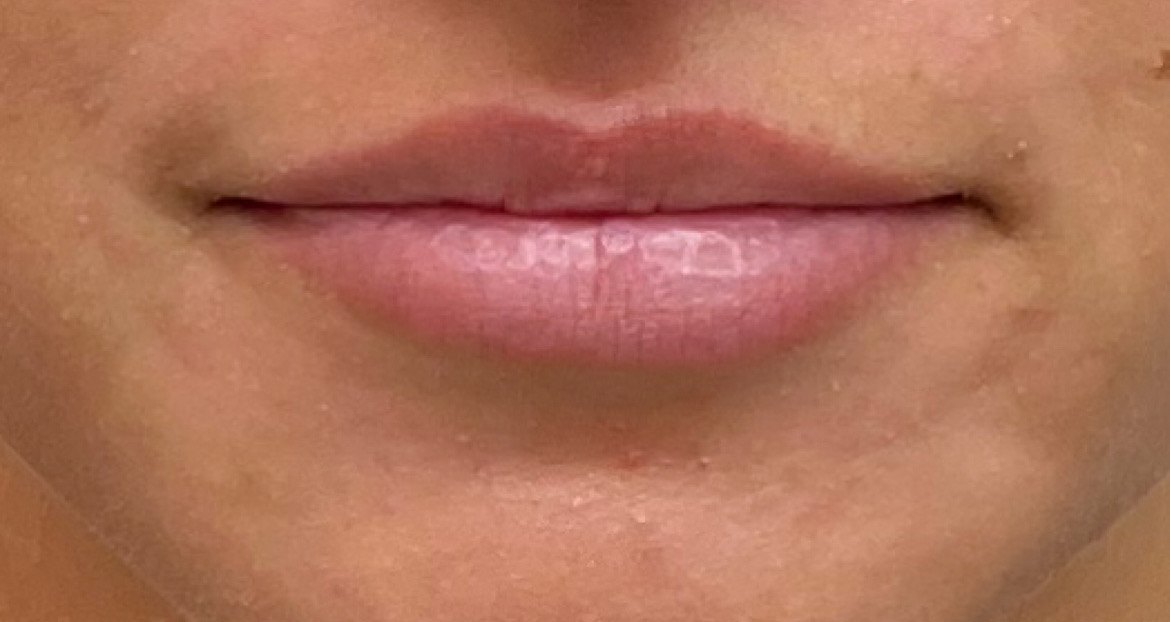 Before Lip Filler Treatment At Anthony Aesthetics In St. Petersburg, Fl
