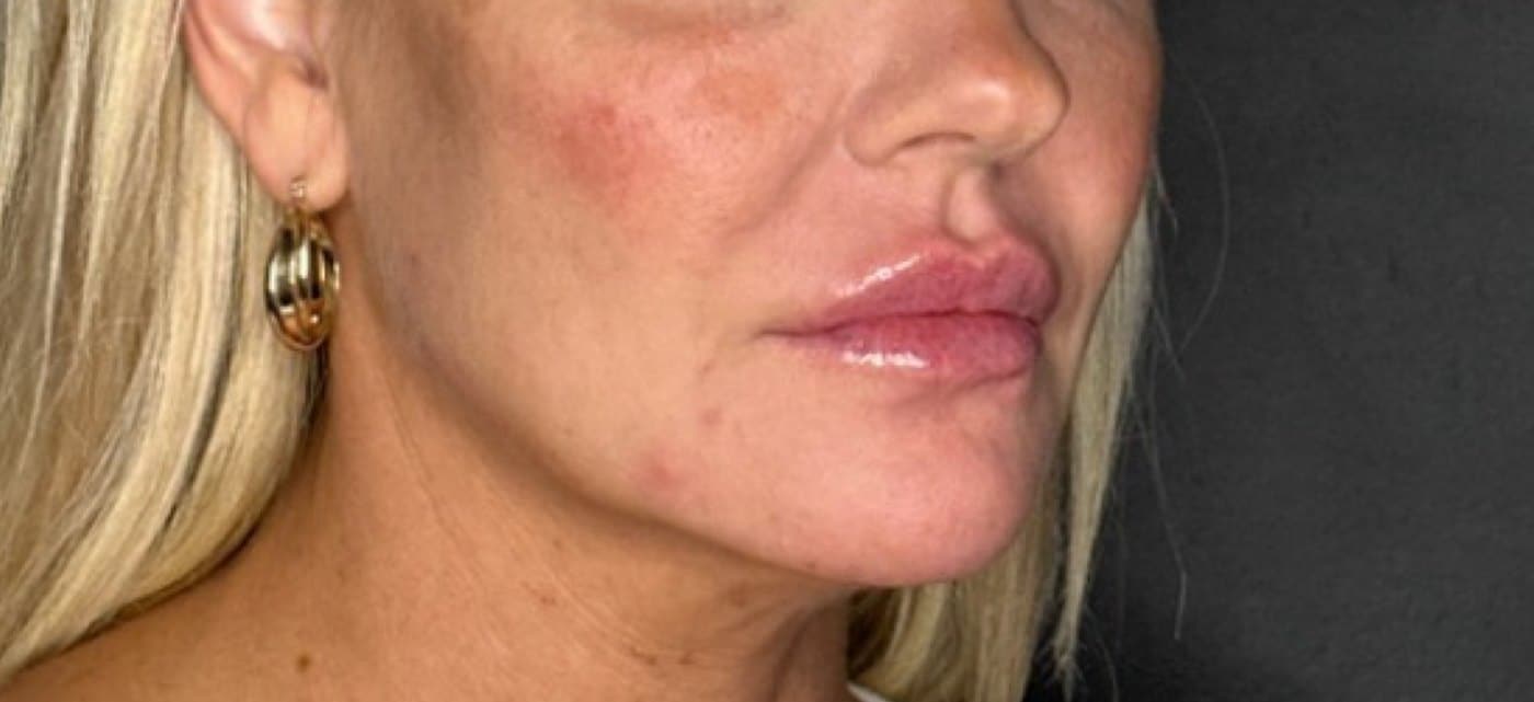 After Prf Skin Rejuvenation Treatment At Anthony Aesthetics In St. Petersburg, Fl