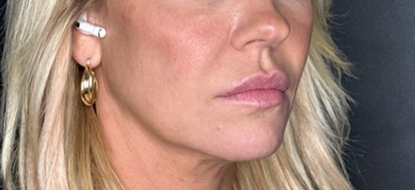 Before Prf Skin Rejuvenation Treatment At Anthony Aesthetics In St. Petersburg, Fl
