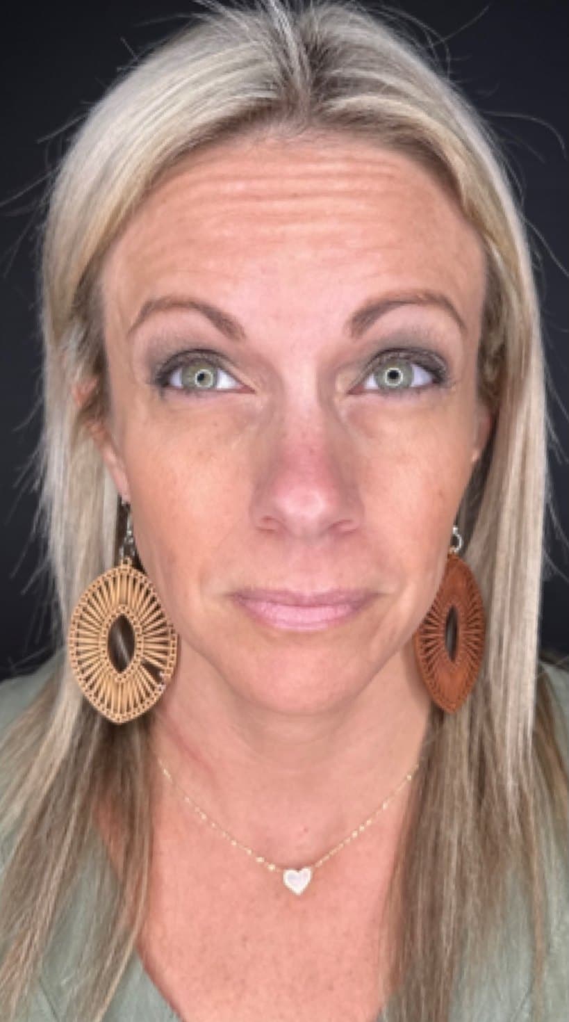 Before Peptide Therapy Treatment At Anthony Aesthetics In St. Petersburg, Fl