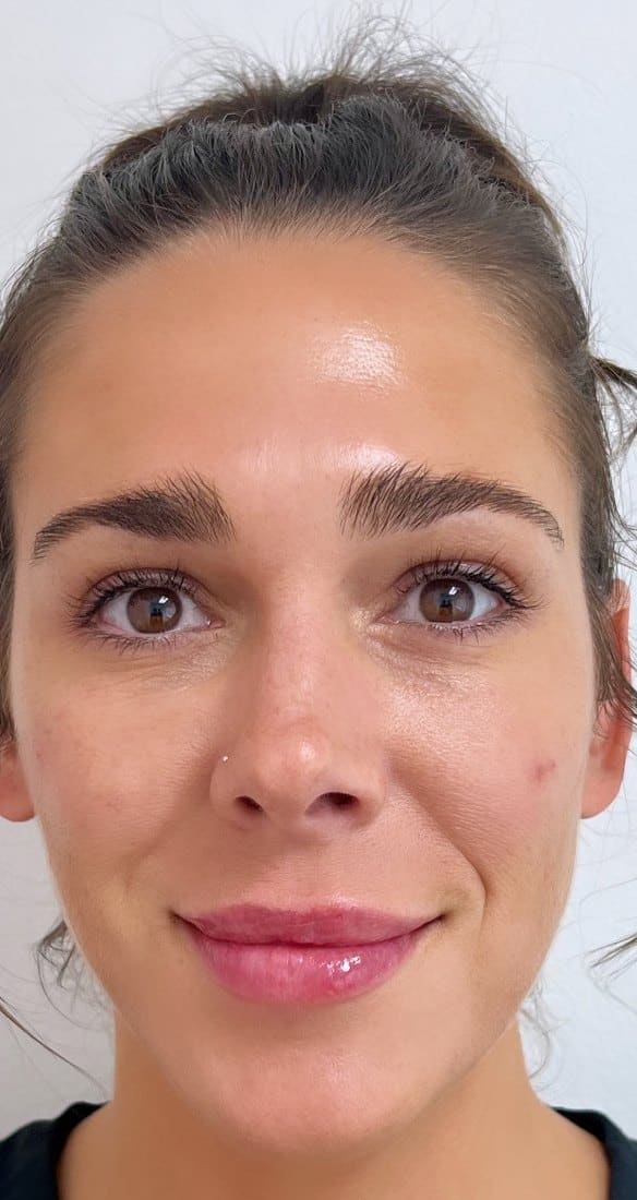 After Under Eye And Cheek Treatment At Anthony Aesthetics In St. Petersburg, Fl